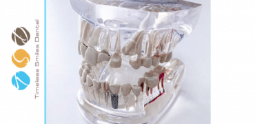 Are dental implants right for you?