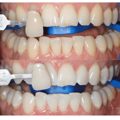Teeth Cleaning before and after