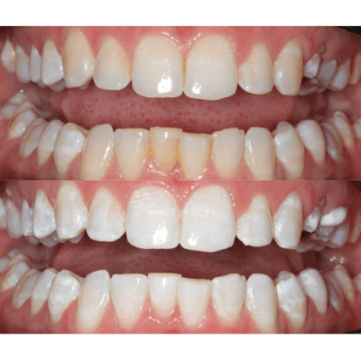 Teeth Cleaning and Aligning Before and After